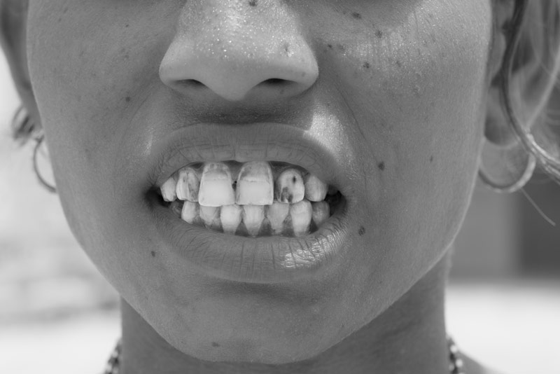 A girl affected by dental fluorosis in a village with fluoride-contaminated drinking water sources in Bikaner district, Rajasthan